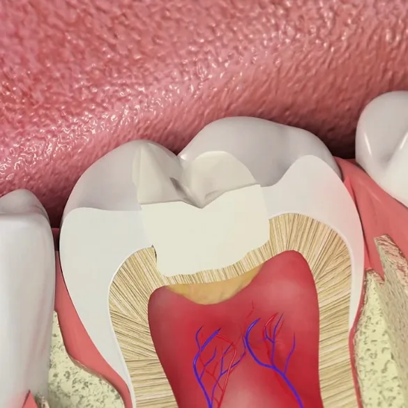 TOOTH FILLING