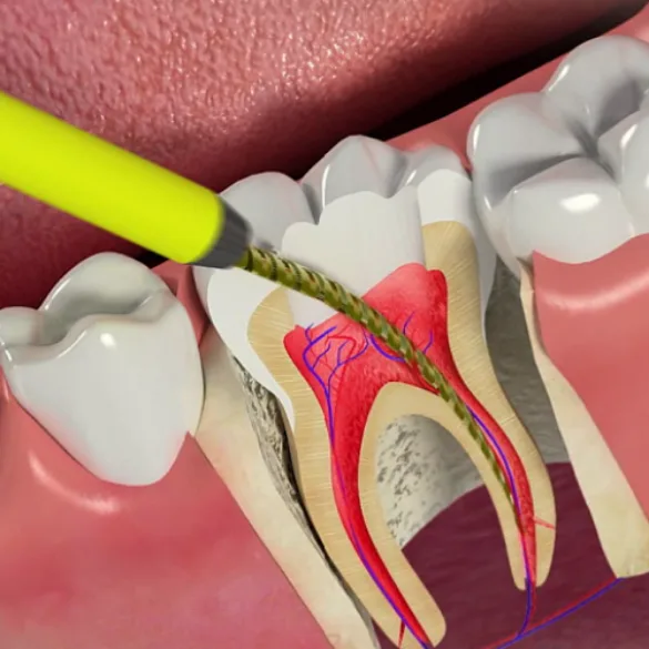 ROOT CANALS TREATMENT