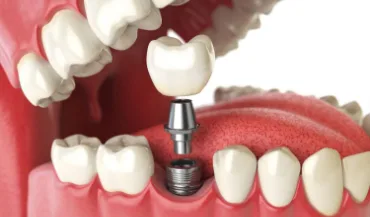 implantaciya
